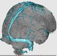 脳静脈 + 脳